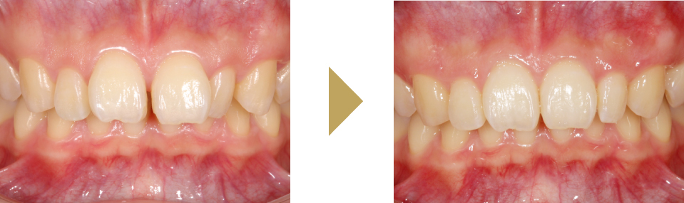 すきっ歯・出っ歯を矯正治療のみで改善した症例