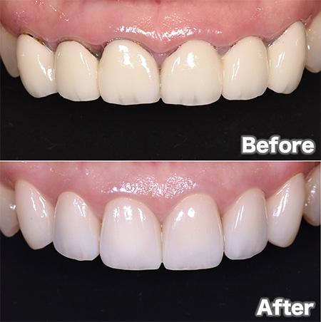 セラミック矯正