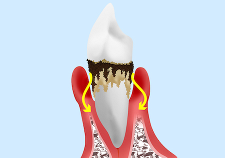 歯周病の原因