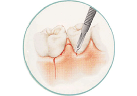 歯周外科治療