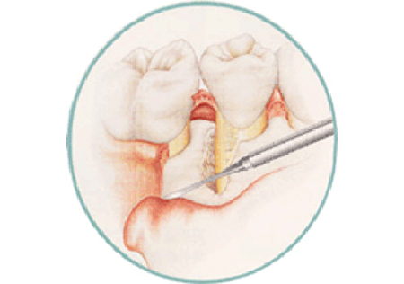 歯周外科治療