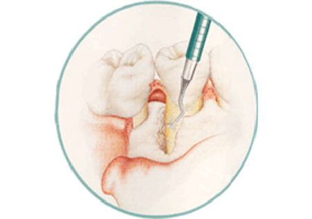 歯周外科治療