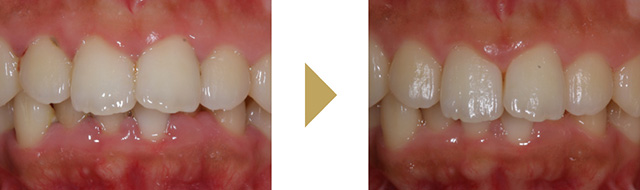 スケーリングルートプレーニングのみで治療