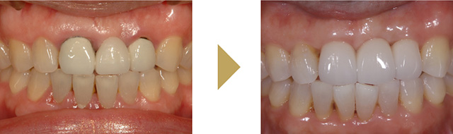 歯周組織再生療法