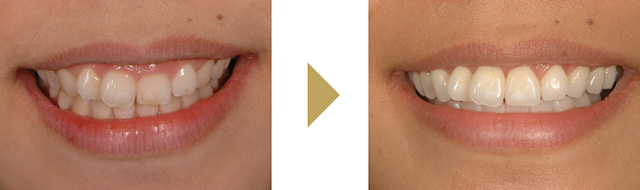 ガミースマイルを治療した歯周形成外科の症例