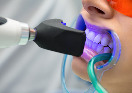 オフィスホワイトニング