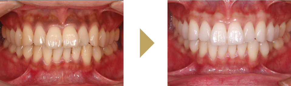 デュアルホワイトニングとガムピーリングを併用した症例